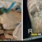 Balita meninggal karena badan penuh cacing