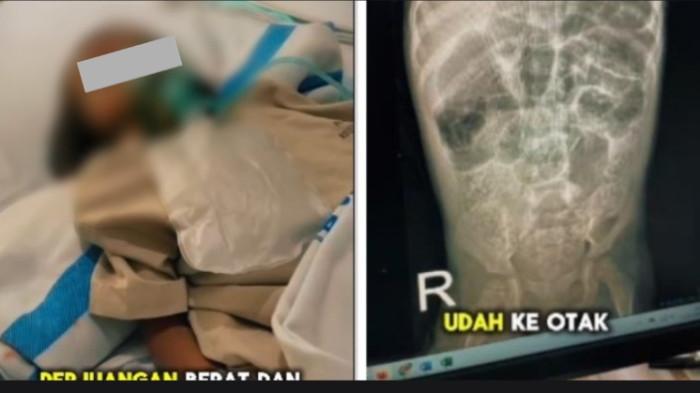 Balita meninggal karena badan penuh cacing