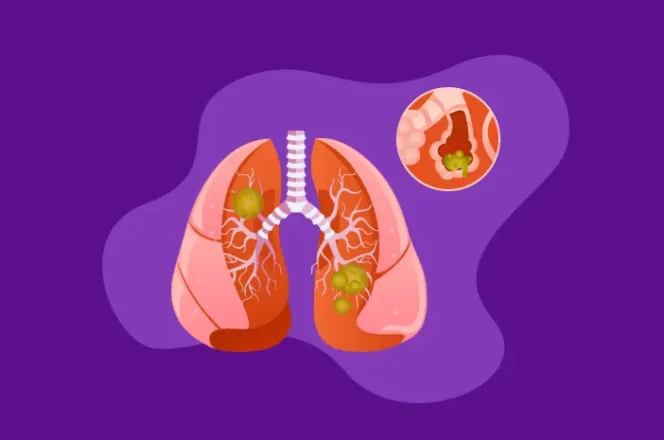 
					Waspada Infeksi Paru-paru! RSUD Cimacan Edukasi Masyarakat Kenali Gejala dan Pencegahan Pneumonia