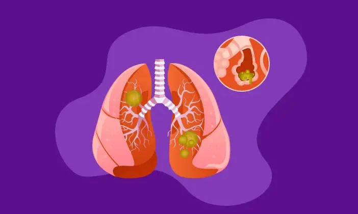 Waspada Infeksi Paru-paru! RSUD Cimacan Edukasi Masyarakat Kenali Gejala dan Pencegahan Pneumonia
